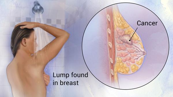 breast cancer dra martha castro tijuana baja california mexico usa