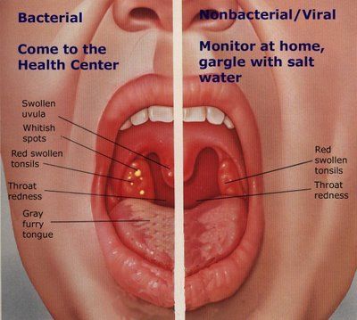 Sore-throat-bacterial-viral-dra-martha-castro-mexico