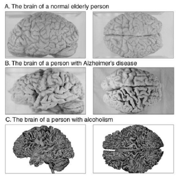 brain damage alcohol drugaddiction health dr martha castro mexico