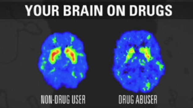 brain damage alcohol drugaddiction health dr martha castro mexico