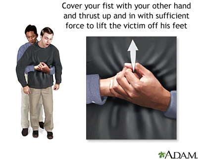 heimlich maneuver teaching saving lives dr martha castro noriega mexico