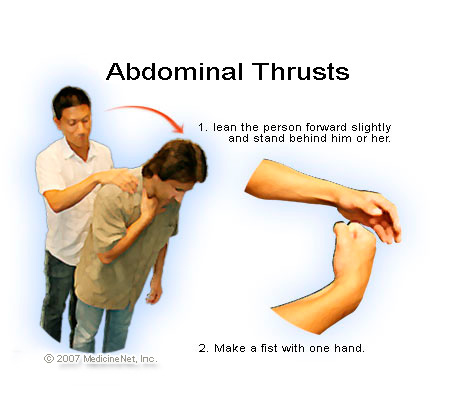 heimlich maneuver teaching saving lives dr martha castro noriega mexico